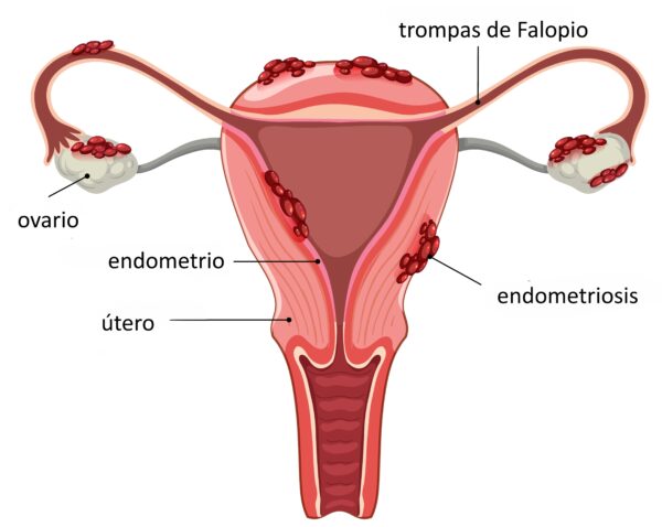 Endometriosis que es