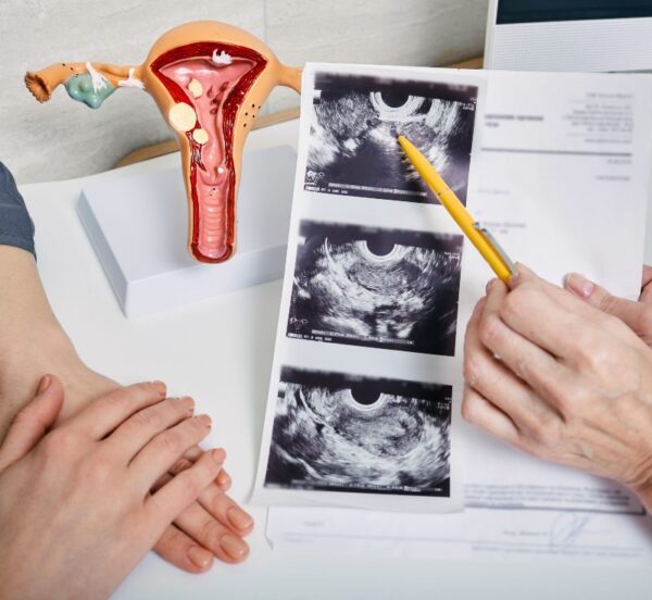 Tratamiento miomas sin cirugía