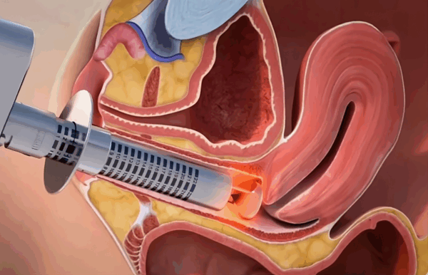 Tratamiento láser vaginal: una alternativa no hormonal